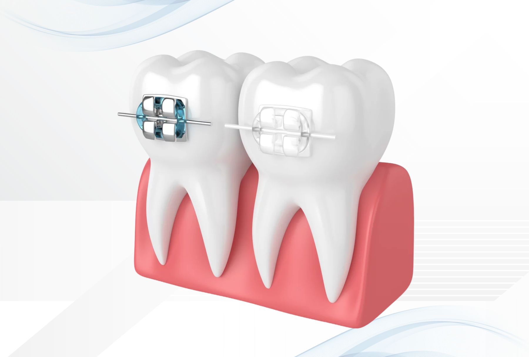 Hybrid Bracket Solutions
