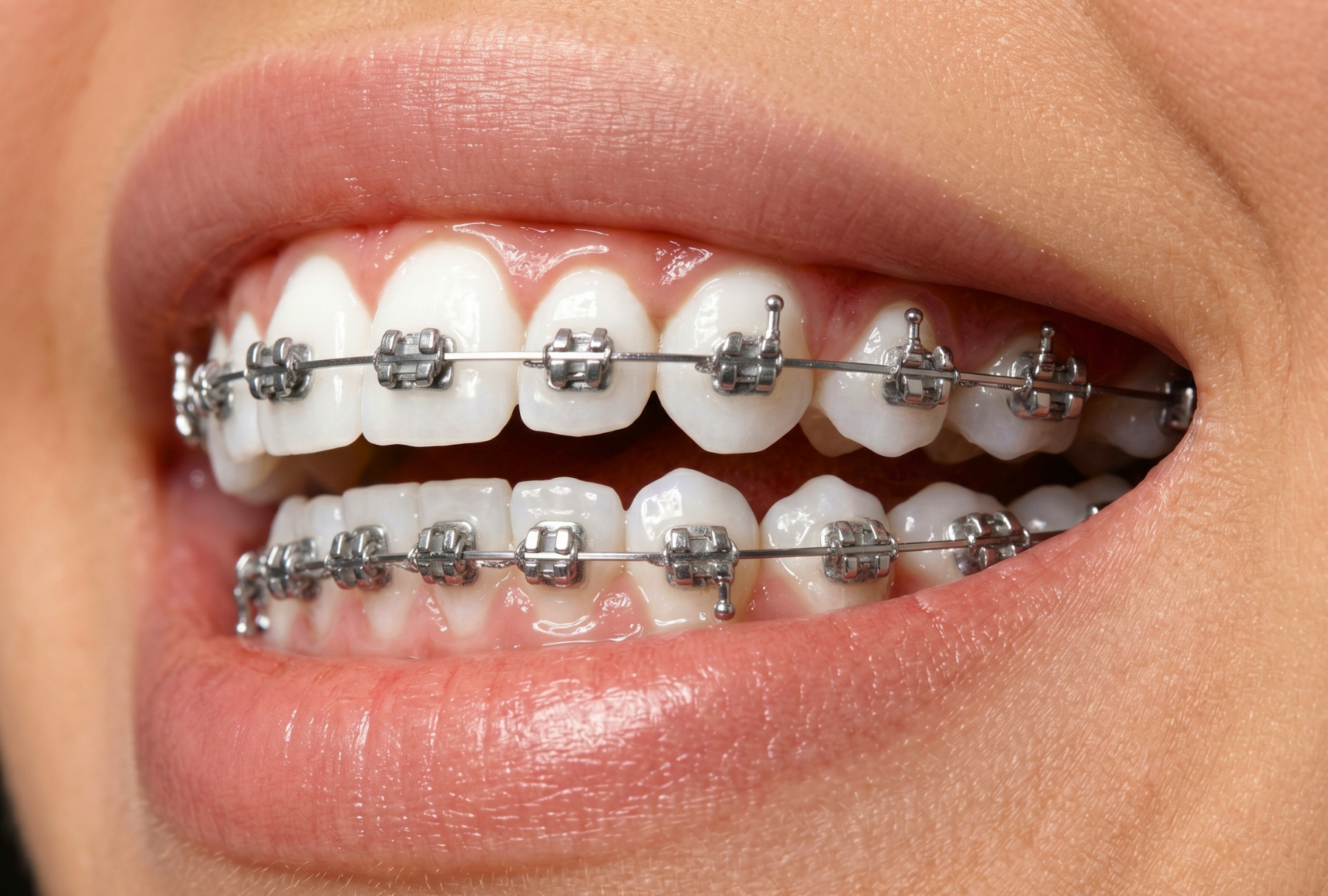 Metal Bracket Systems