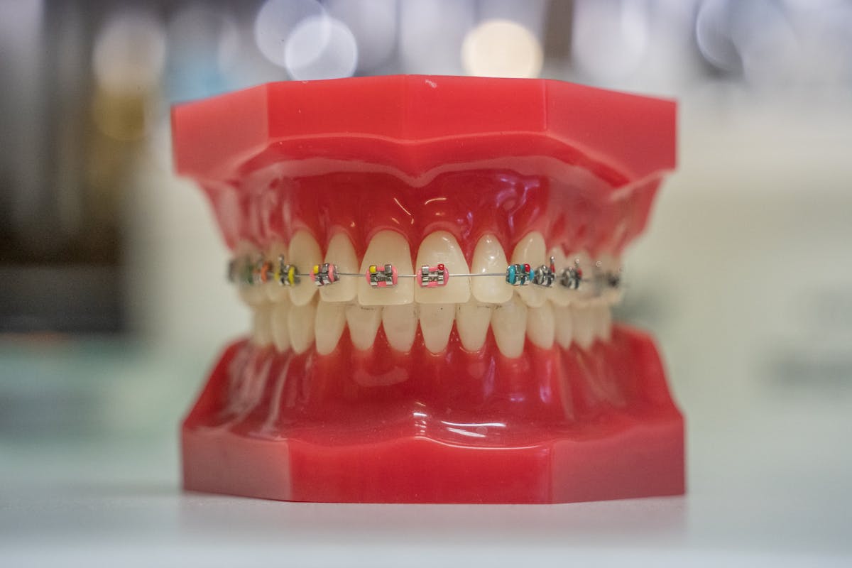 CDB ceramic dental brackets on model